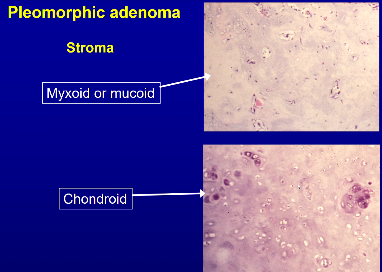 <p>Mucoid/myxoid → few cells, more blueish, more loose</p><p>Chondroid → more cartilage cells</p>