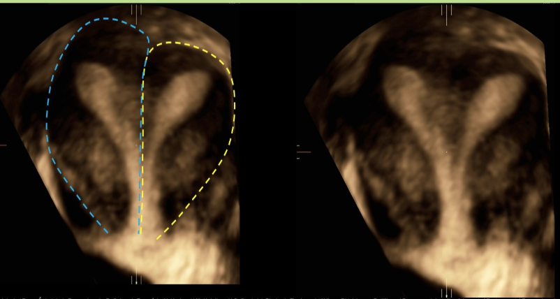 <p>a pt has suspected uterine <strong>didelphys</strong>. if the exam is positive for the anomaly, what do you expect to find</p><p>a) a right + left uterine body w/single cervix + vaginal canal</p><p>b) a right + left uterine body, cervix, and vaginal canal</p><p>c) single uterine body connected to 2 cervixes + 2 vaginal canals</p><p>d) a right + left uterine body and cervix that are both connected a single vaginal canal</p>
