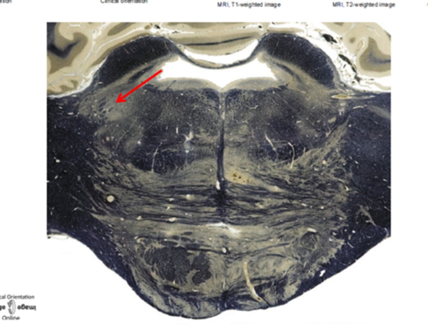 <p>this nucleus contains motor neurons that innervate the muscles of mastication</p>