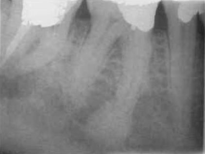 <p>tooth is <strong>vital</strong></p><p>no treatment needed</p><p>typical around <span style="color: red;"><span>lower 1st molar region</span></span></p><p>shows a <span style="color: red;"><span>radiopaque area within</span></span> the lesion</p><p>PDL space remains <span style="color: red;"><span>continuous around roots</span></span></p>