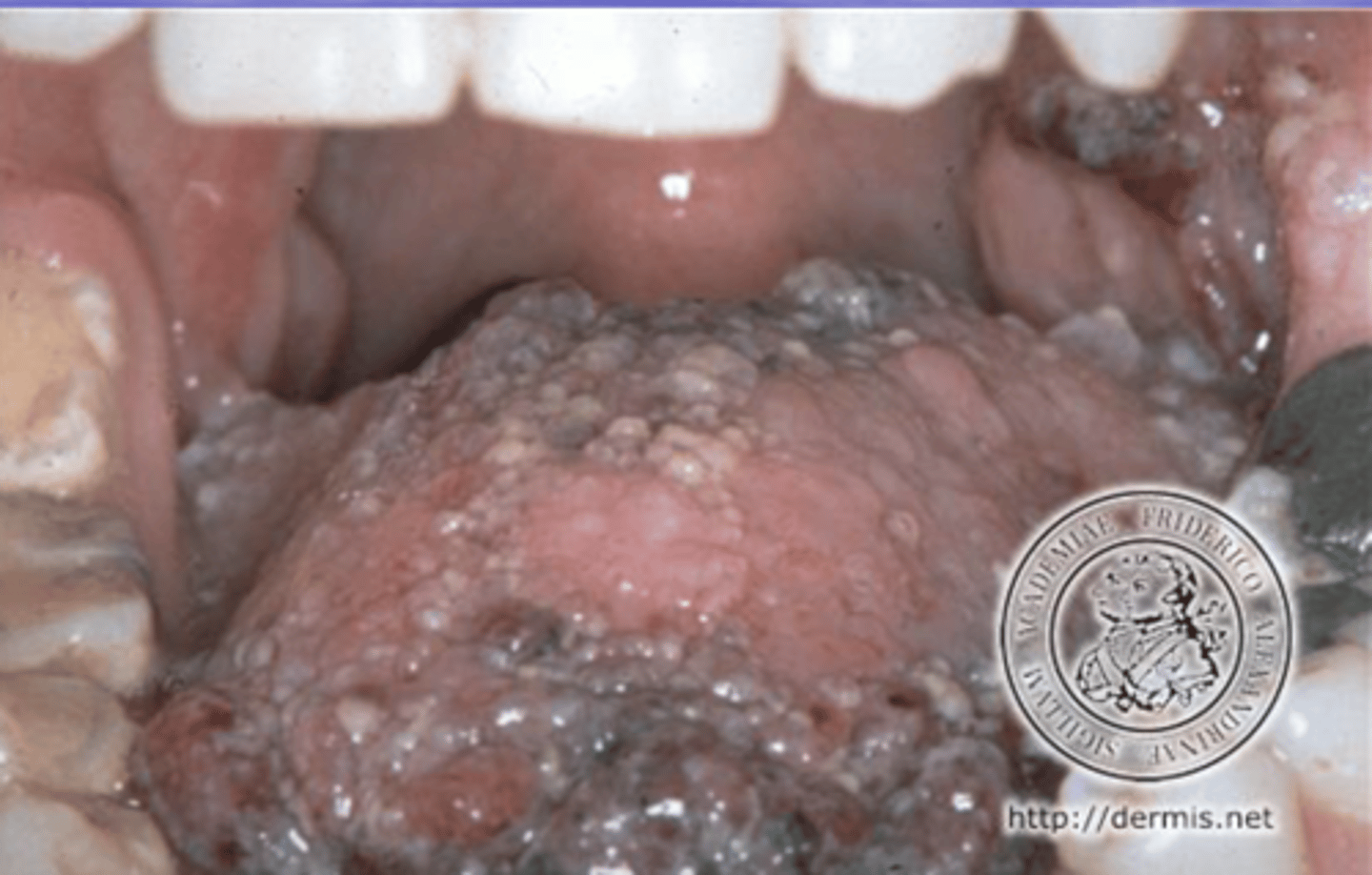 <p>benign tumor/hyperplasia of lymphatic vessels</p>