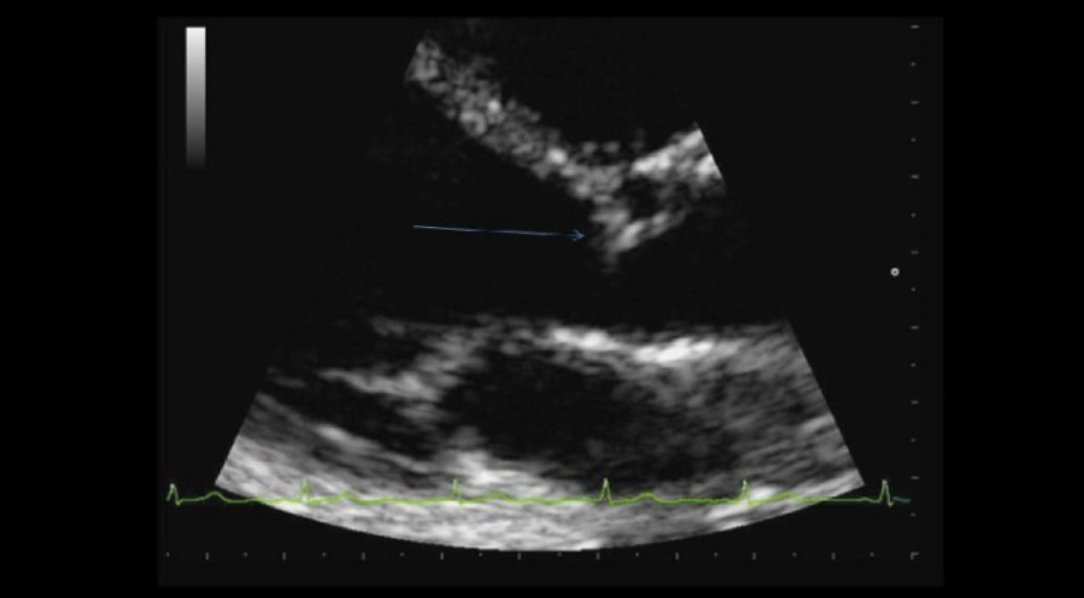 <p>An eccentric line of closure of the AV common sign of? </p>