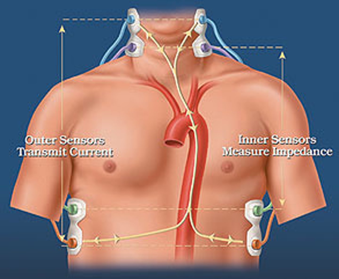 <p>impedance cardiography</p>