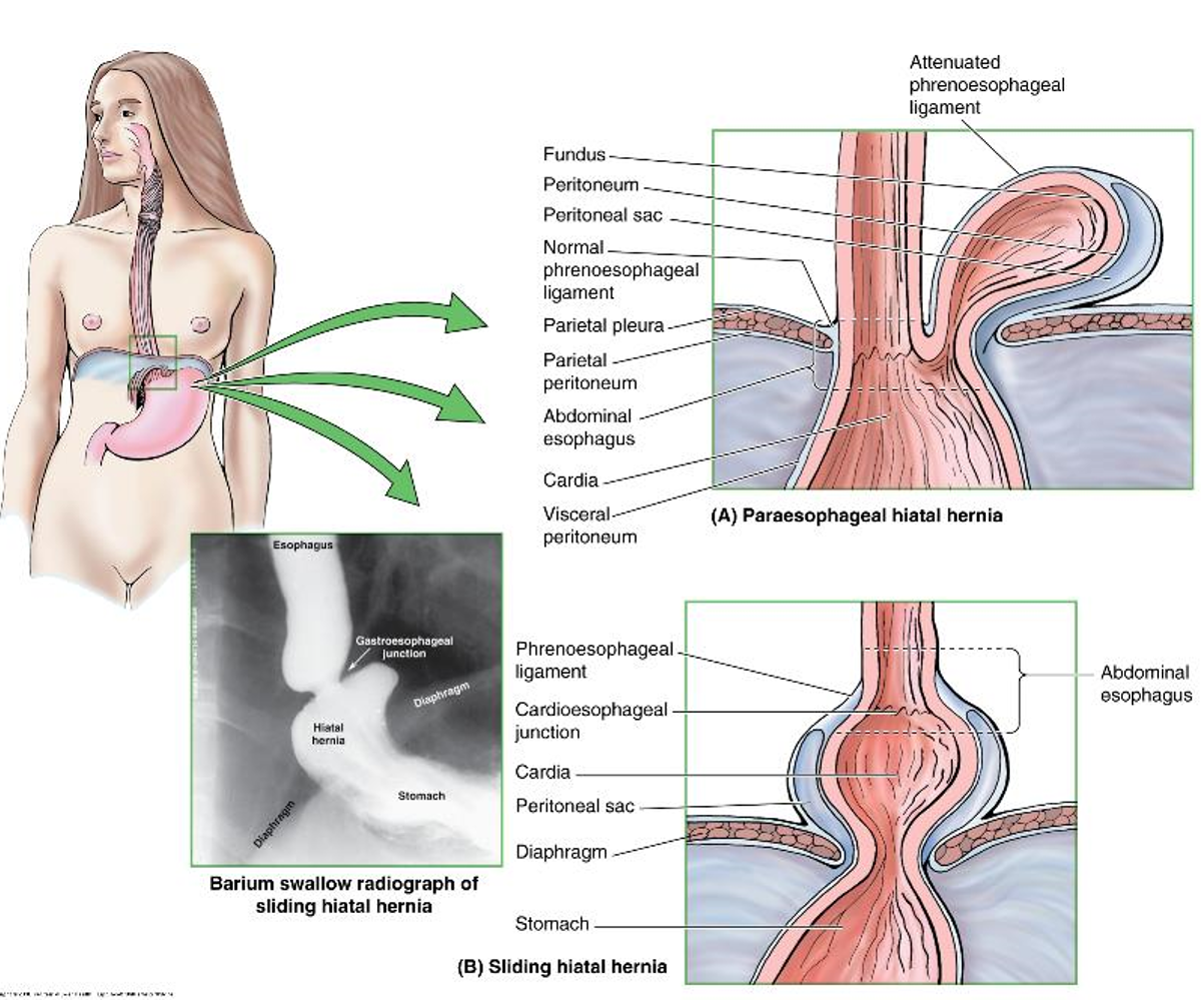 <p>A <strong>paraesophageal hiatal hernia</strong> involves the stomach's <strong>fundus</strong> moving up while the <strong>cardia</strong> stays in place and usually does not cause reflux. </p><p>A <strong>sliding hiatal hernia</strong> involves both the <strong>cardia</strong> and part of the esophagus moving up, often leading to acid reflux.</p>