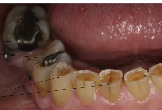 <ul><li><p class="p1"><strong>Findings:</strong></p><ul><li><p class="p1">Extensive loss of occlusal surface</p></li><li><p class="p1">Edges of metallic restorations stand above tooth structure</p></li></ul><p></p></li><li><p class="p1"><strong>Progression:</strong></p><ul><li><p class="p1">Rapid dentin destruction</p></li><li><p class="p1">Concave depression of dentin</p></li><li><p class="p1">Surrounded by elevated rim of enamel</p></li></ul></li></ul><p></p>