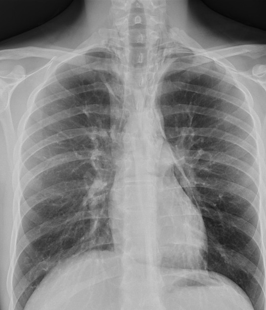 <p>Describe the abnormality demonstrated. </p>