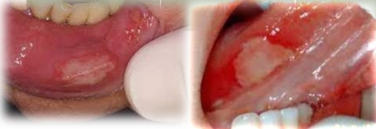 <p><strong><u>Traumatic ulcer</u></strong></p><p class="has-focus">Most common oral ulcer</p><p class="has-focus">May indicate:</p><p class="has-focus">Child abuse</p><p class="has-focus">Neurologic impairment</p><p class="has-focus">Factitial injuries when peristent and recurrent</p><p class="has-focus"></p><p class="has-focus is-empty"><strong>Treatment </strong>- Typically heals in 1-3 weeks. Symptomatic relief, eliminate cause. Factitial ulcers are diagnostic problem. May heal with scarring.</p><p class="has-focus"></p><p class="has-focus is-empty"><em>DD - Apthous ulcer, Mucosal burn Secondary herpetic ulcer, Contact allergy</em></p>