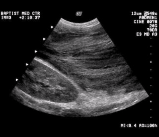 <ul><li><p><span style="background-color: transparent;">Inflammation spreads along fascial pathways → localized area of diffuse inflammatory edema of soft tissue → can lead to necrosis or suppuration</span></p></li><li><p><span style="background-color: transparent;">Involves lesser sac, LT anterior pararenal space, or transverse colon</span></p></li><li><p><span style="background-color: transparent;">Sonographic appearance: hypoechoic ill-defined mass</span></p></li></ul><p></p>