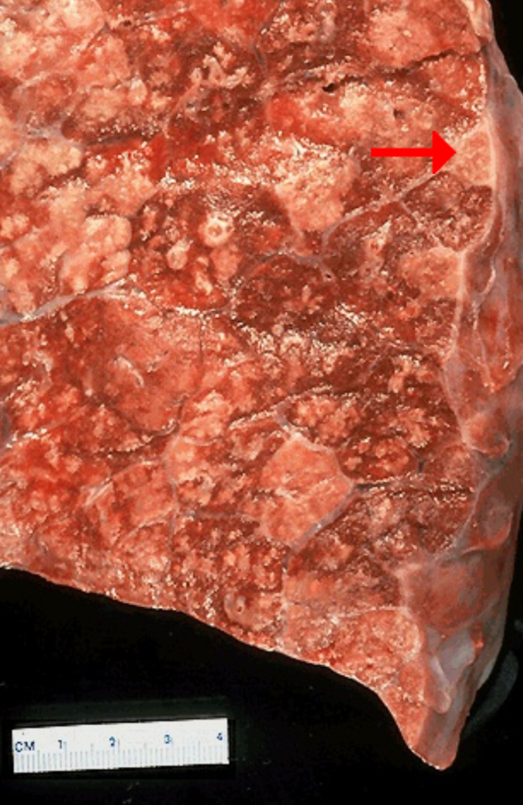 <ol><li><p>Abscess</p></li><li><p>Neutrophils</p></li></ol><p></p><p>A lung abscess is typically a complication of severe pneumonia, most often from virulent organisms such as <em>Staphylococcus aureus</em>, some pneumococci, and <em>Klebsiella pneumoniae</em>.</p><p></p>