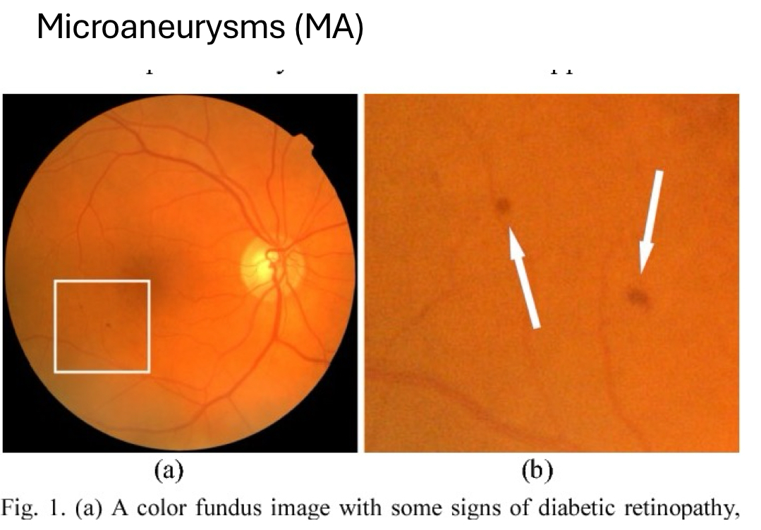<p>earliest sign of diabetic retinopathy </p><ul><li><p>focal enlargement of capillary walls/outpouching due to weakening of capillary walls</p></li><li><p>INL (hyper-reflective ring, non-homo inner content on OCT)</p></li><li><p>temporal to fovea typically</p></li><li><p>potential to be a permanent finding in retina</p></li><li><p>best seen with FA, OCT-A</p></li></ul><p></p>