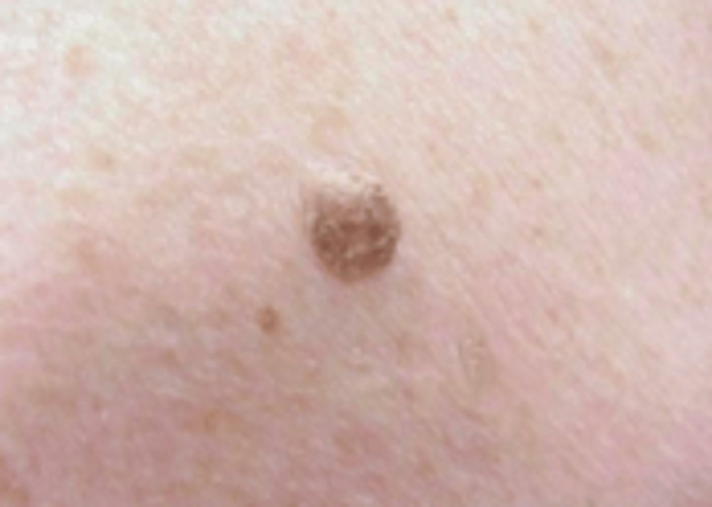 <p>Keratotic Disorders:</p><p>Objective:</p><p>- Initially 1 or more sharply defined, light brown, flat lesions with a velvety to finely verrucous surface</p><p>- Arise on normal skin and &lt;1 cm</p><p>- Can become thicker with time and become deeply pigmented without light reflection</p><p>- Can be covered by greasy-appearing scale and are raised above the surface of the skin</p><p>- Round–oval, multiple lesions may be aligned in direction of skin folds (light brown, round lesion with greasy appearance)</p>