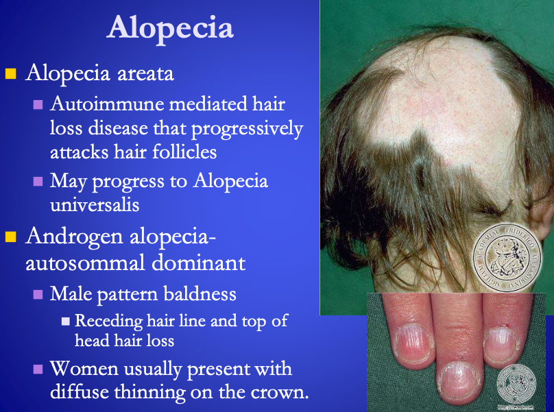 <p><span><strong>[...]</strong></span></p><ul><li><p>Autoimmune mediated hair loss that progressively attacks hair follicles</p></li><li><p>May progress to <span>alopecia universalis</span></p></li></ul><p></p>