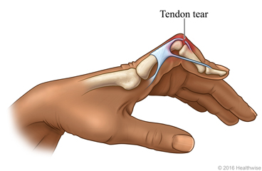 <p>A patient with finger trauma shows flexion at the PIP joint and hyperextension at the DIP joint. What is this deformity called?</p>