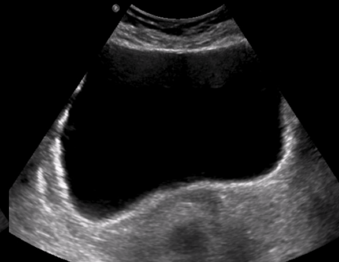 <p>Is this a trans or long image of the bladder?</p>