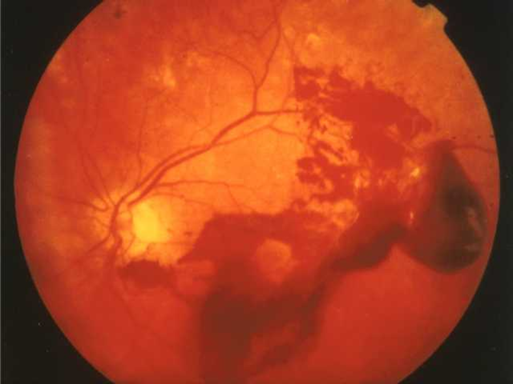 Vitreous haemorrhage