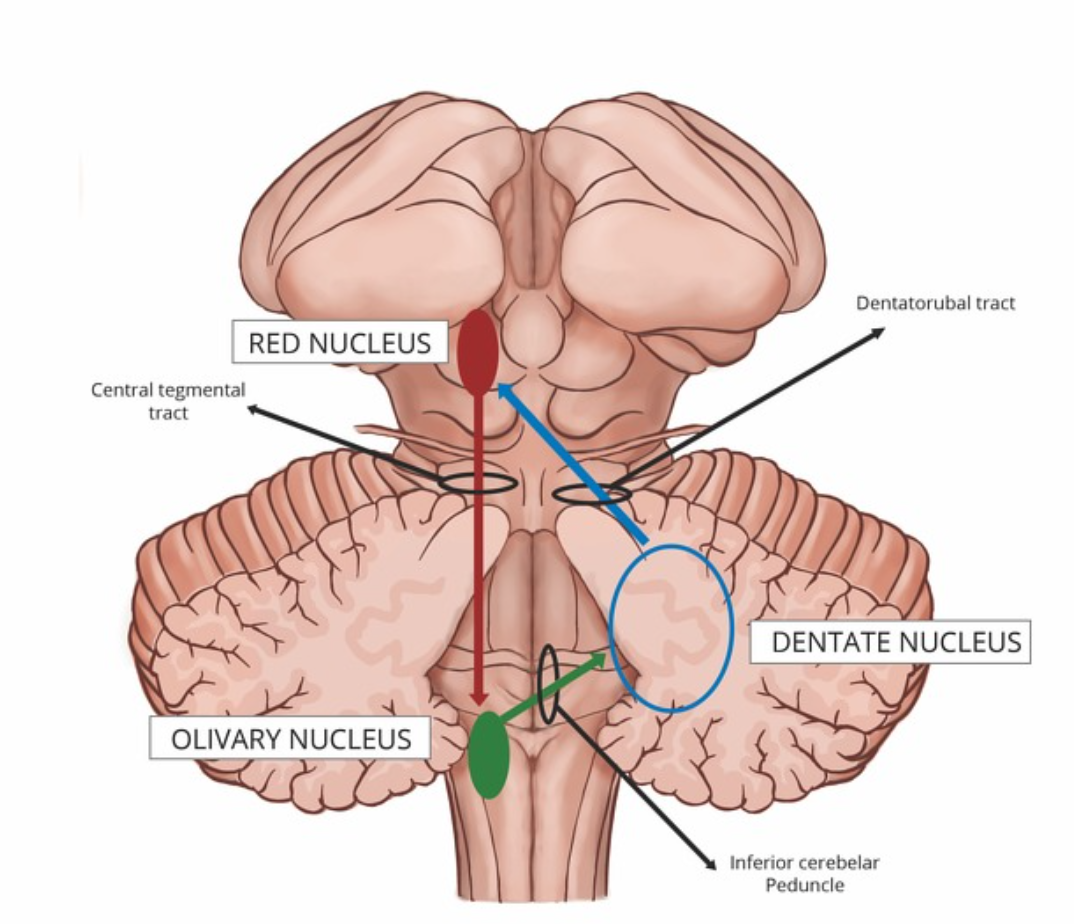<p>Inferior olivary nucleus</p>