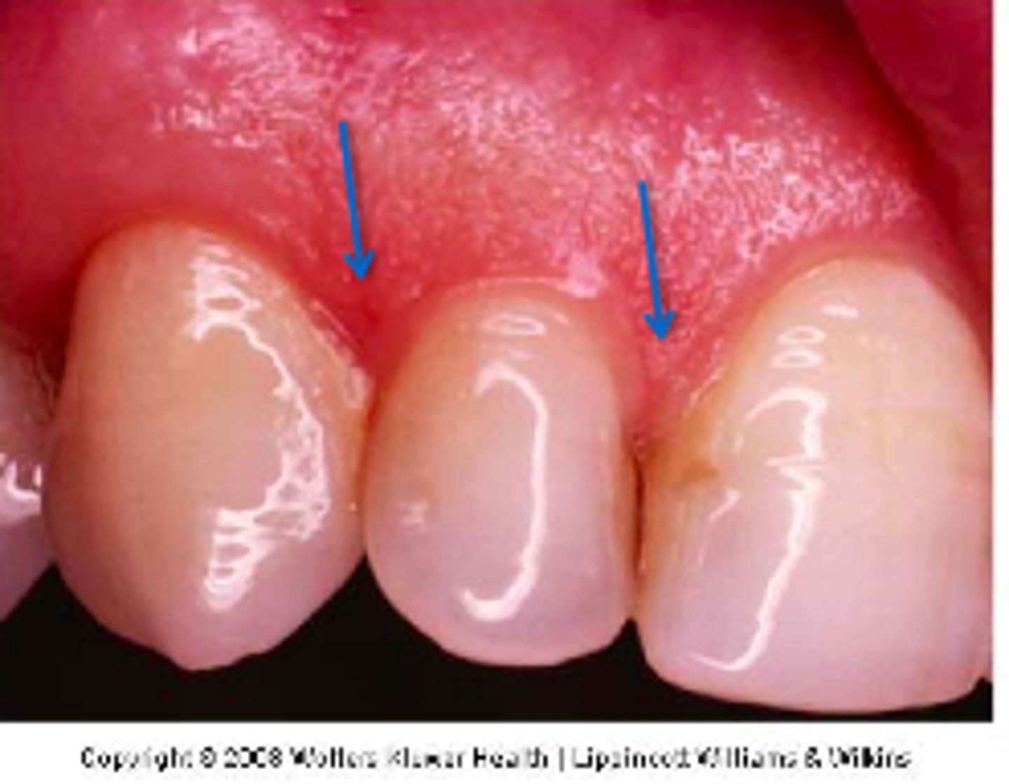 <p>free gingiva between teeth</p>