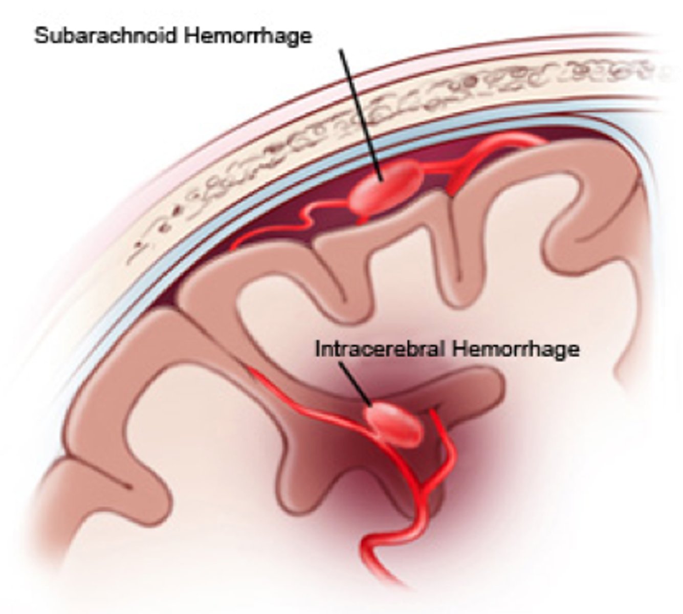 <p>Bleeding into the substance of the brain tissue</p><p>Smaller arteries that supply deeper structure can haemorrhage</p><p>Most commonly occur due to vascular disease (hypertension)</p>