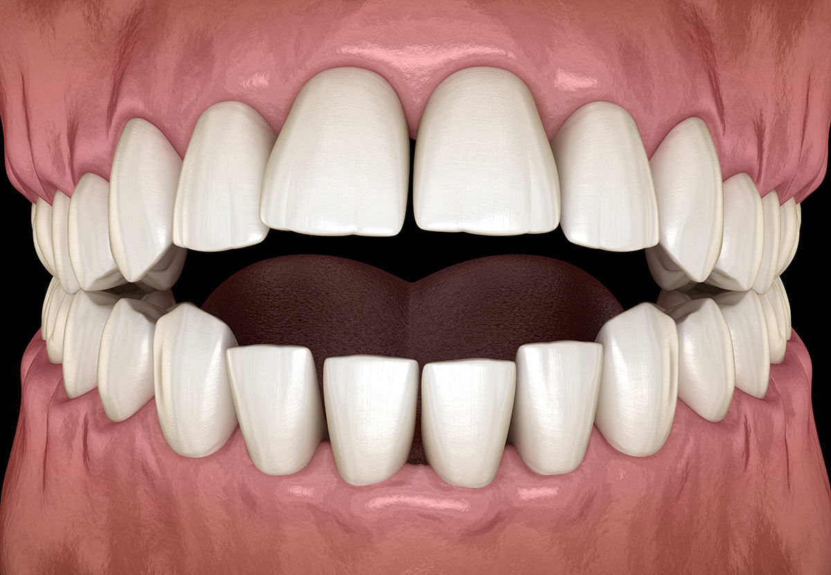 <p>open bite </p>