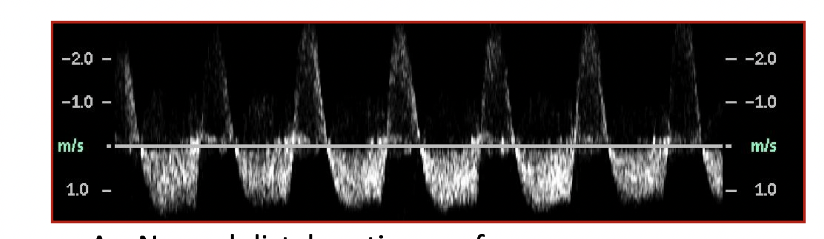 <p>The following waveforms were recorded during an abdominal duplex exam in a patient who had undergone abdominal aortic surgery, what does it show?</p>
