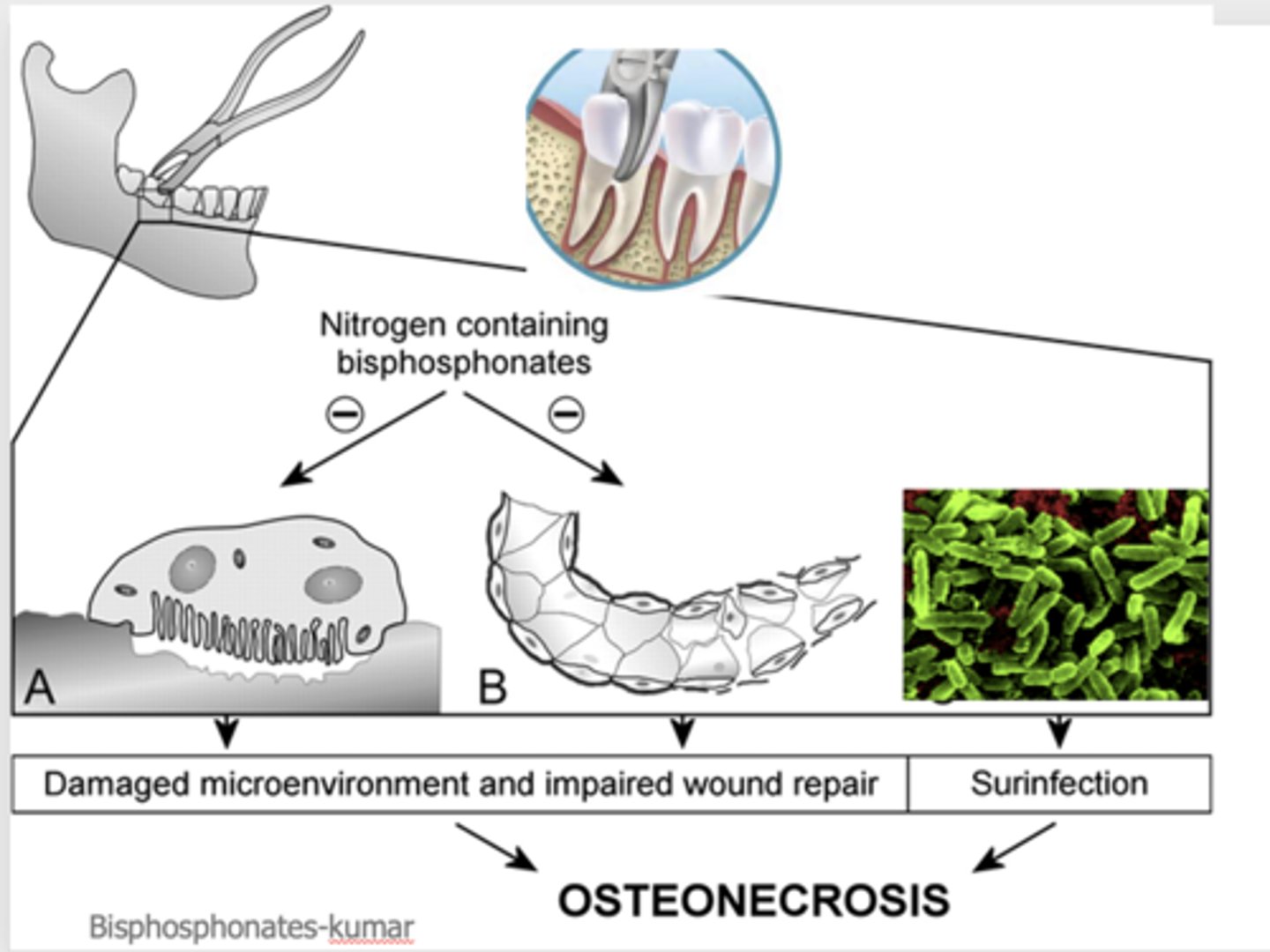 <p>Osteonecrosis</p>