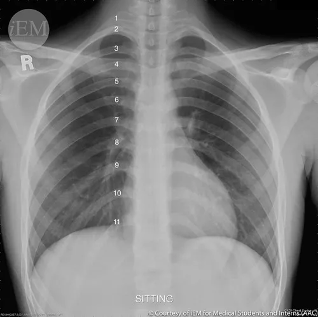 <p>An AP projection is not useful for the sternum because it is superimposed with the vertebral spine and mediastinum, making differentiation of its parts difficult.</p>