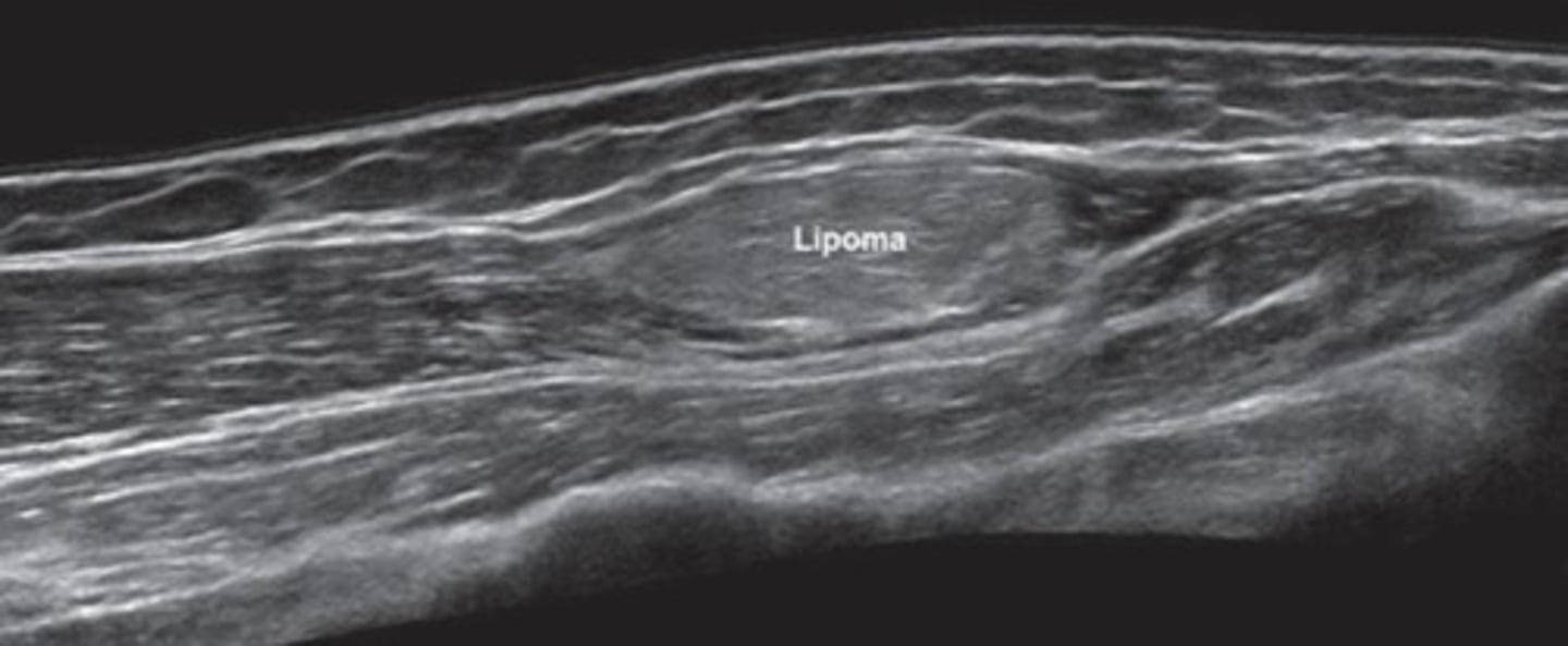 <p>Benign, fatty tumor</p><p>Isoechoic (mostly) to hyperechoic</p>