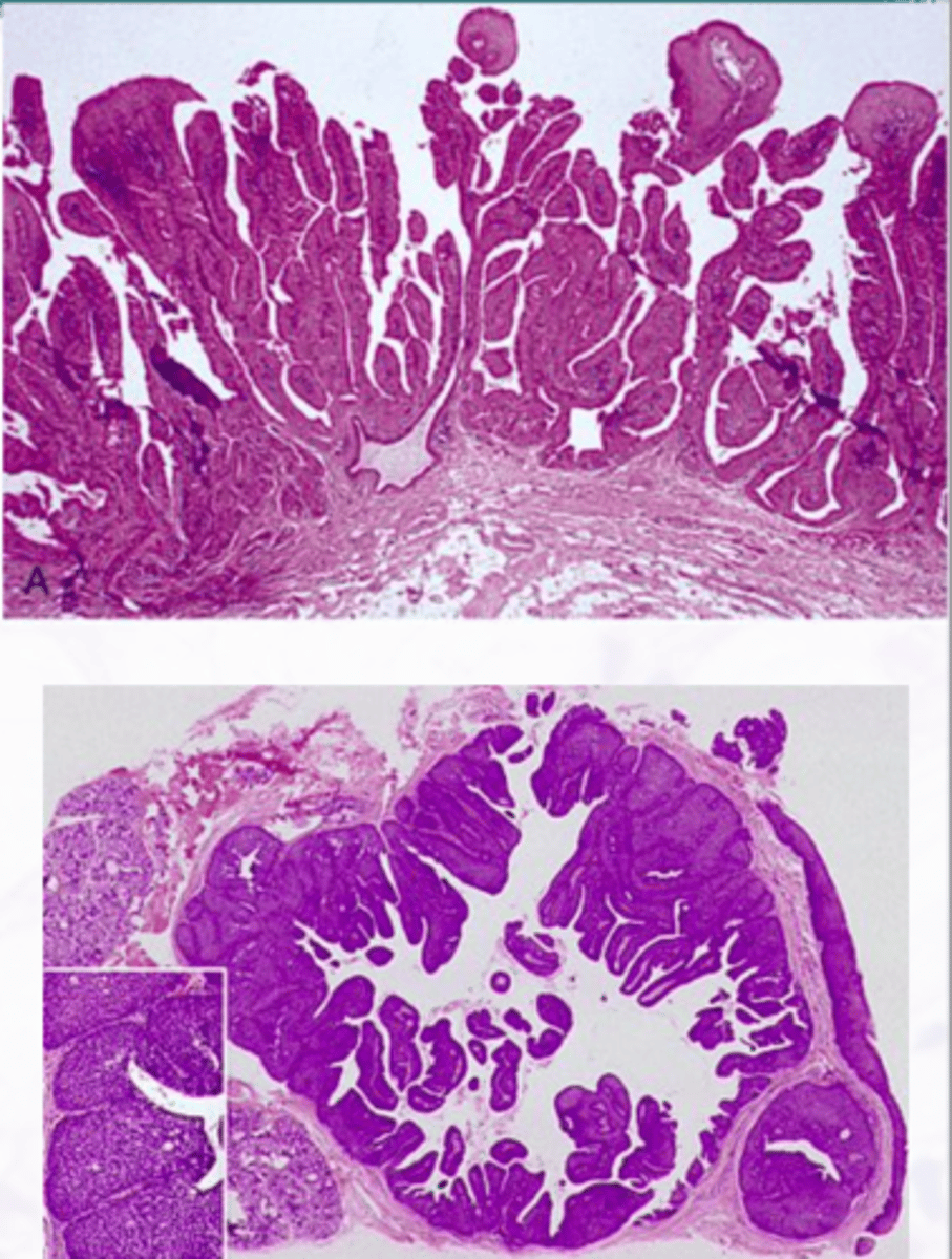 <p>• Papillary projections</p><p>• Inflammation</p><p>• Intraductal</p><p>▫ inside a duct</p>