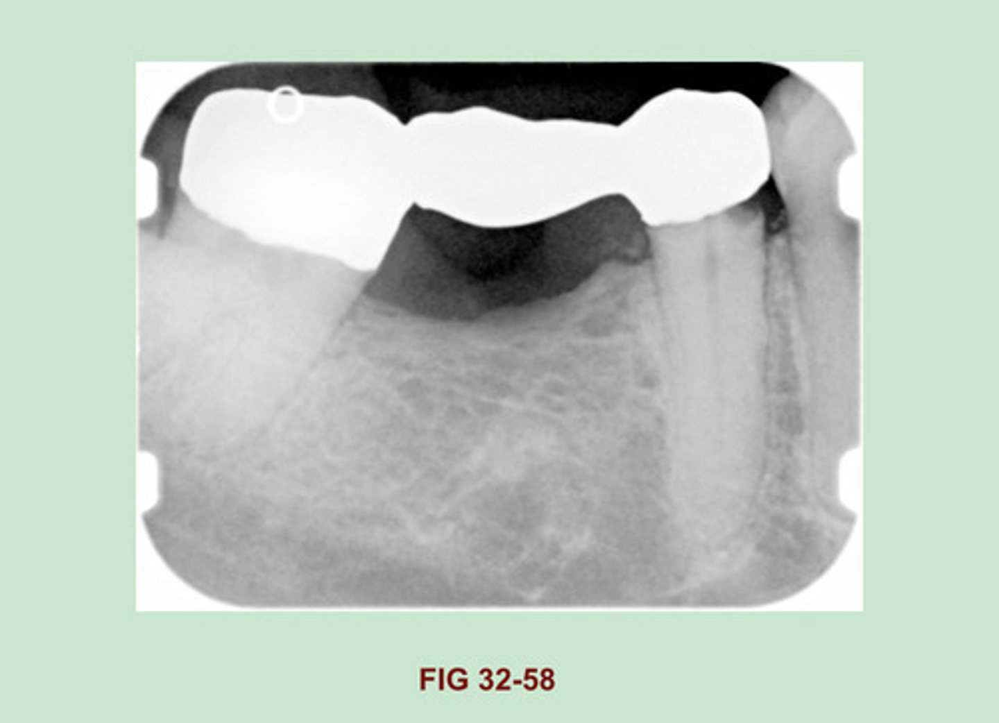 <p>Gold bridge</p><p>Side Note: Gold crowns & bridges appear as large radiopaque restorations with SMOOTH CONTOURS & REGULAR BORDERS. Similarly, gold inlay & onlay restorations exhibit marginal outlines that appear smooth & regular.</p>