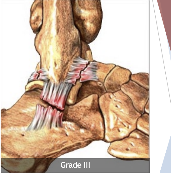 <p>3rd degree sprain</p>