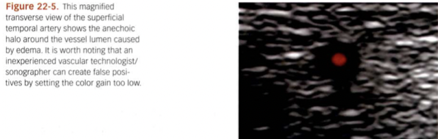 <p>Inflammation of superficial temporal artery. Patient typically complain of headaches. Sono findings appear like “halo” inside vessels.</p>