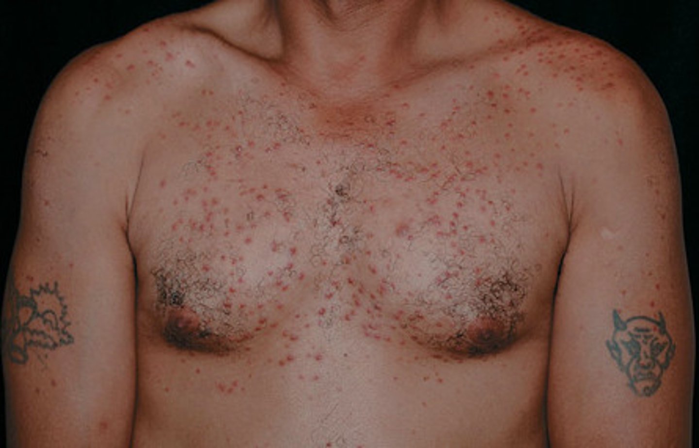 <p>Occurs on the trunk and extremities after immersion in a hot tub</p><p>Pseudomonas aeruginosa </p><p>Self-limiting </p>