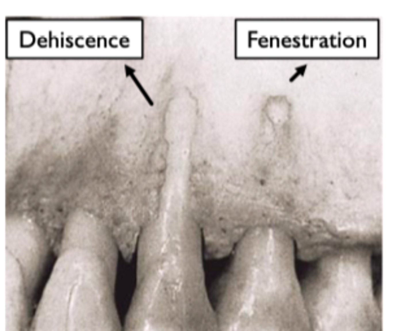 <p>lack of bone</p><p>tooth is normally procline through a thin sheet of bone</p><p>associated with recession as the ginivae is pulled down to the level of the bone</p>