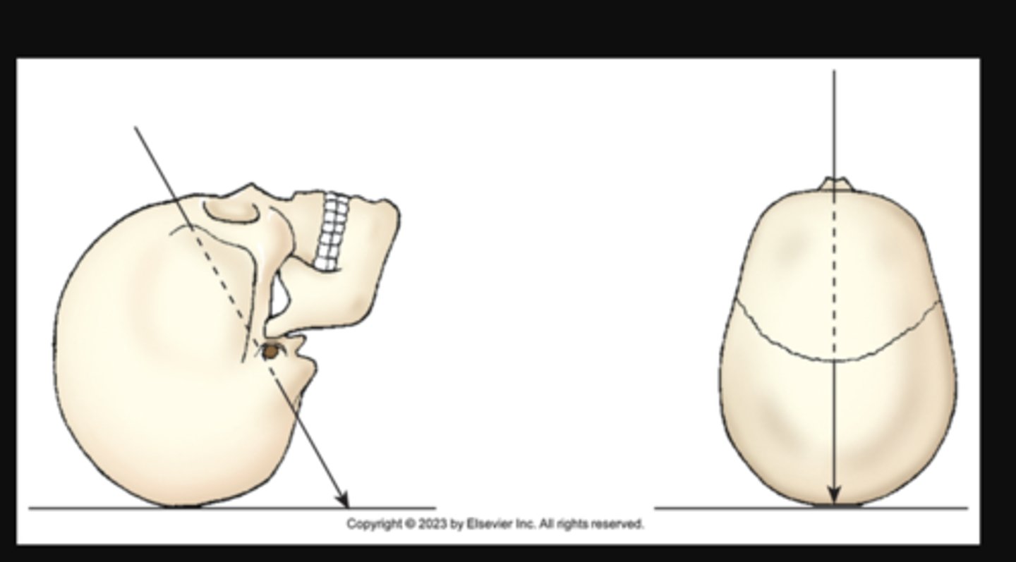 <p>longitudinal angulation of the central ray toward the head (cephalad) or the feet (caudad)</p><p>AP X projection of skull. Central ray enters anterior aspect at an angle and exits posterior aspect.</p>