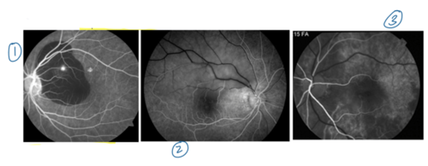 <p>1. blockage = hemorrhage, pigment, exudate, media opacity in front of the BV</p><p>2. impaired vascular filling = choroidal BV, retinal arteries/veins/arterioles/venules/capillaries, ON capillaries</p><p>3. atrophy of a perfused structure = ON, choroid, retina</p>
