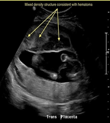 <p>which condition requires <strong>immediate delivery</strong> of the fetus</p><p>.</p><p>a) twin to twin transfusion</p><p>b) placental abruption</p><p>c) placenta previa</p><p>d) placenta accreta</p>