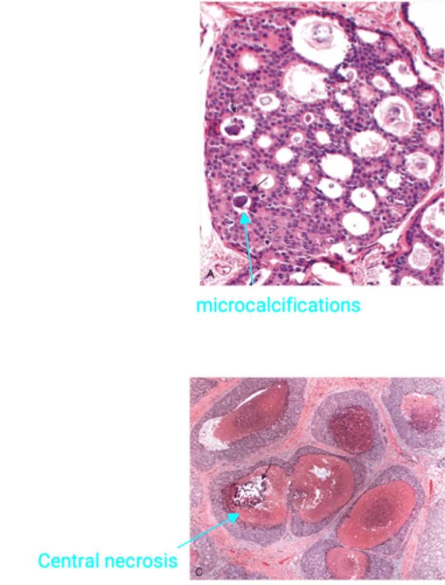 <p>Define Type of Breast Cancer:</p><p>Malignant proliferation of cells in ducts with no invasion of the basement membrane</p><p>-Dx:</p><p>&gt; A/w Microcalcifications (usually no mass, but detected on Mammogram --&gt; get BIOPSY to distinguish btwn benign and malignant)</p><p>&gt; Comedonecrosis (Central necrosis) and dystrophic calcifications in center of ducts</p><p>-Prog:</p><p>&gt; HIGH Risk of cancer progression</p><p>&gt; Risk of carcinoma in SAME breast</p><p>&gt; Best Predictors for Recurrence/Progression = Nuclear grade &amp; Necrosis</p>