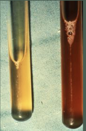 <p>You are an equine surgeon and a colleague referred you a horse with colic. He felt small intestinal distention on rectal exam and got the peritoneal fluid depicted in the image on the left. You see the horse a couple of hours later and get the sample in the image on the right. Does this horse need surgery?</p>