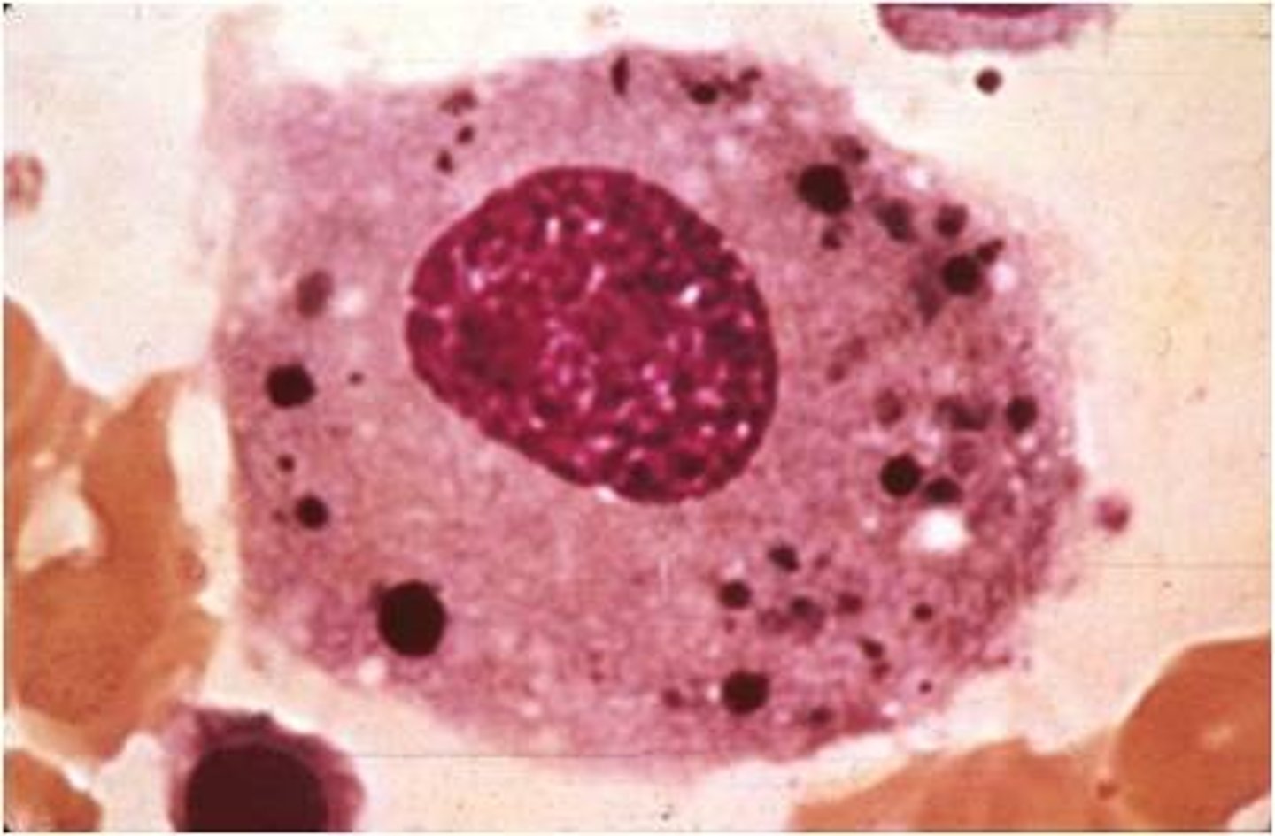 <p>huge, weird shape, round nucleus, vacuoles, in tissue but not PB<br>-nurse rbc in bm</p>