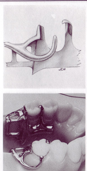 <p>I-Bar</p><p>Pros </p><ul><li><p>Allows denture movement during function to prevent tooth trauma </p></li><li><p>Good aesthetics </p></li><li><p>Minimal tooth contact </p></li></ul><p>Cons </p><ul><li><p>Poor bracing </p></li><li><p>Teeth need prep </p></li></ul>