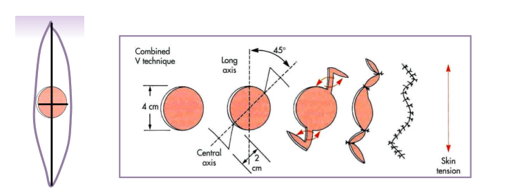 <ul><li><p>difficult to close because of dog ears </p></li><li><p>perform a linear closure </p><ul><li><p>easier with smaller defects </p></li><li><p>close parallel with line of tension </p></li><li><p>* start in the center of the wound </p></li><li><p>correct the dog ears </p></li></ul></li><li><p>convert to ellipse </p><ul><li><p>easier with smaller defects as well </p><ul><li><p>resects more skin than necessary </p></li></ul></li><li><p>4:1 length to width ratio </p></li><li><p>eliminates dog ears </p></li><li><p>adequate surgical preparation </p></li></ul></li><li><p>combined V - good with lesion by eye </p><ul><li><p>45 degrees from axis of tension </p></li><li><p>additional skin is not removed </p></li></ul></li></ul><p></p>