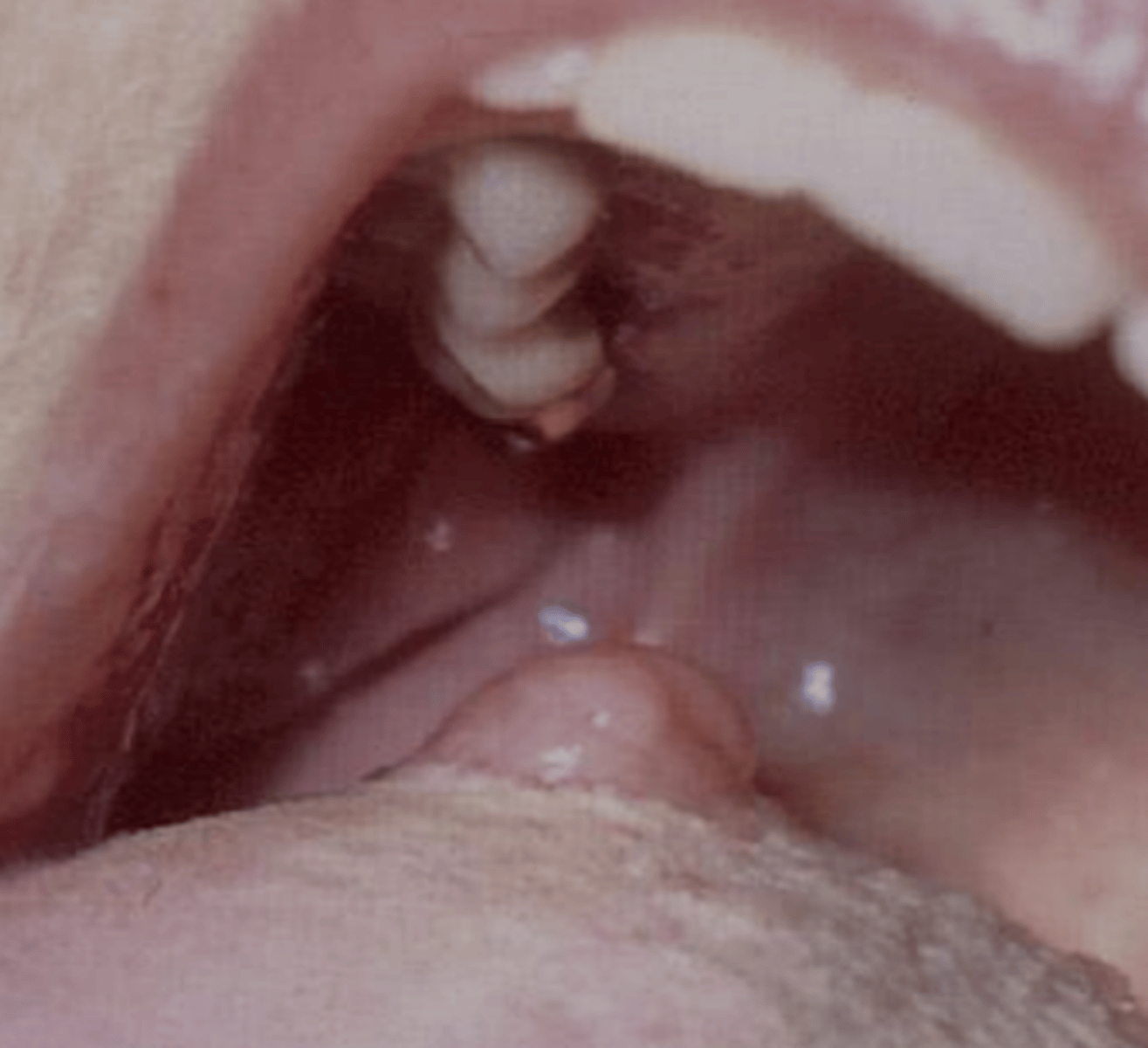 <p>Polymorphous Adenocarcinoma</p>
