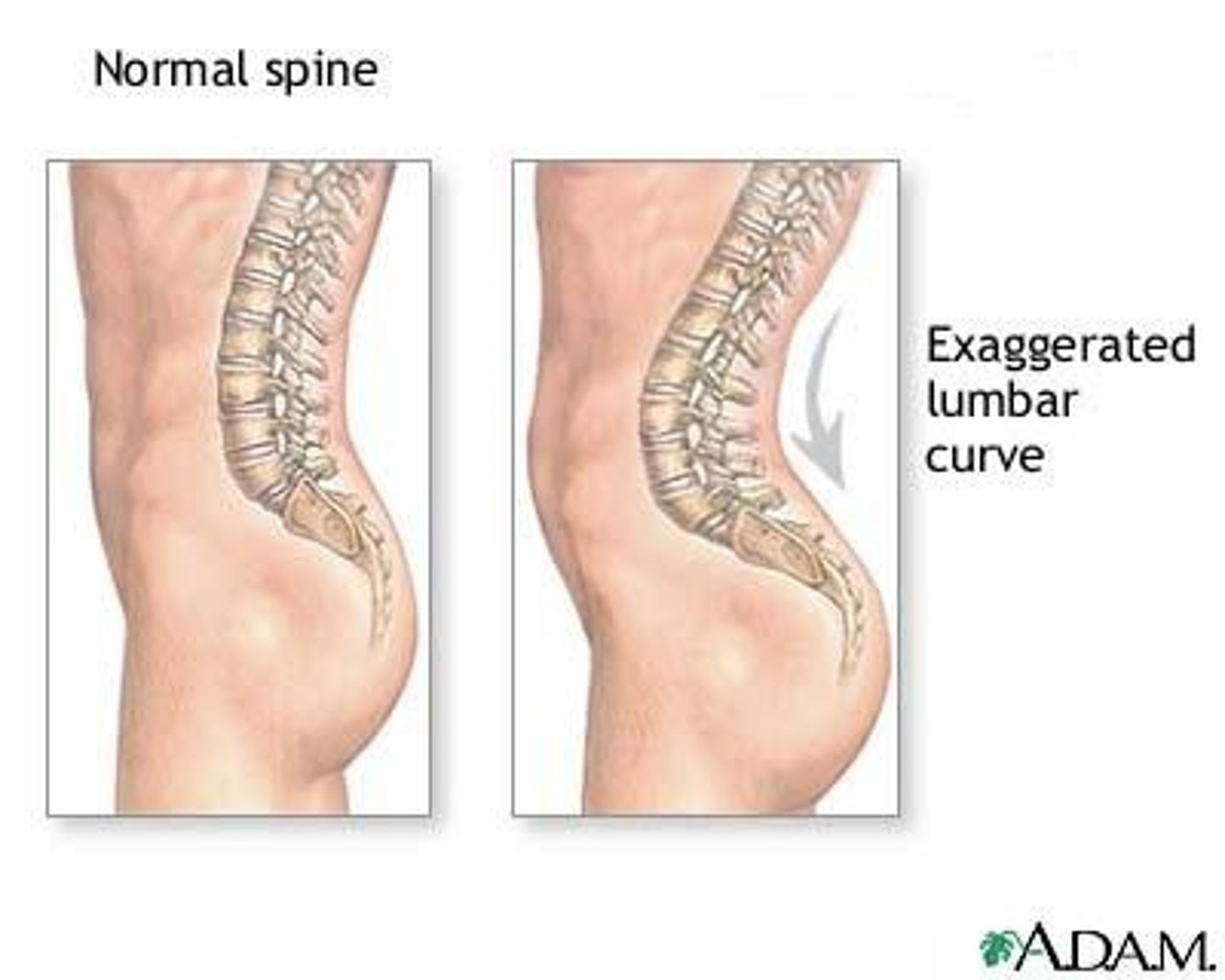 <p>Exaggerated lumbar curvature.</p>