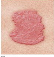 <p>Papule group that formed legions larger than 0.5cm </p><p>Psoriasis, actinic ,keratosis, lichen planus</p><p></p>