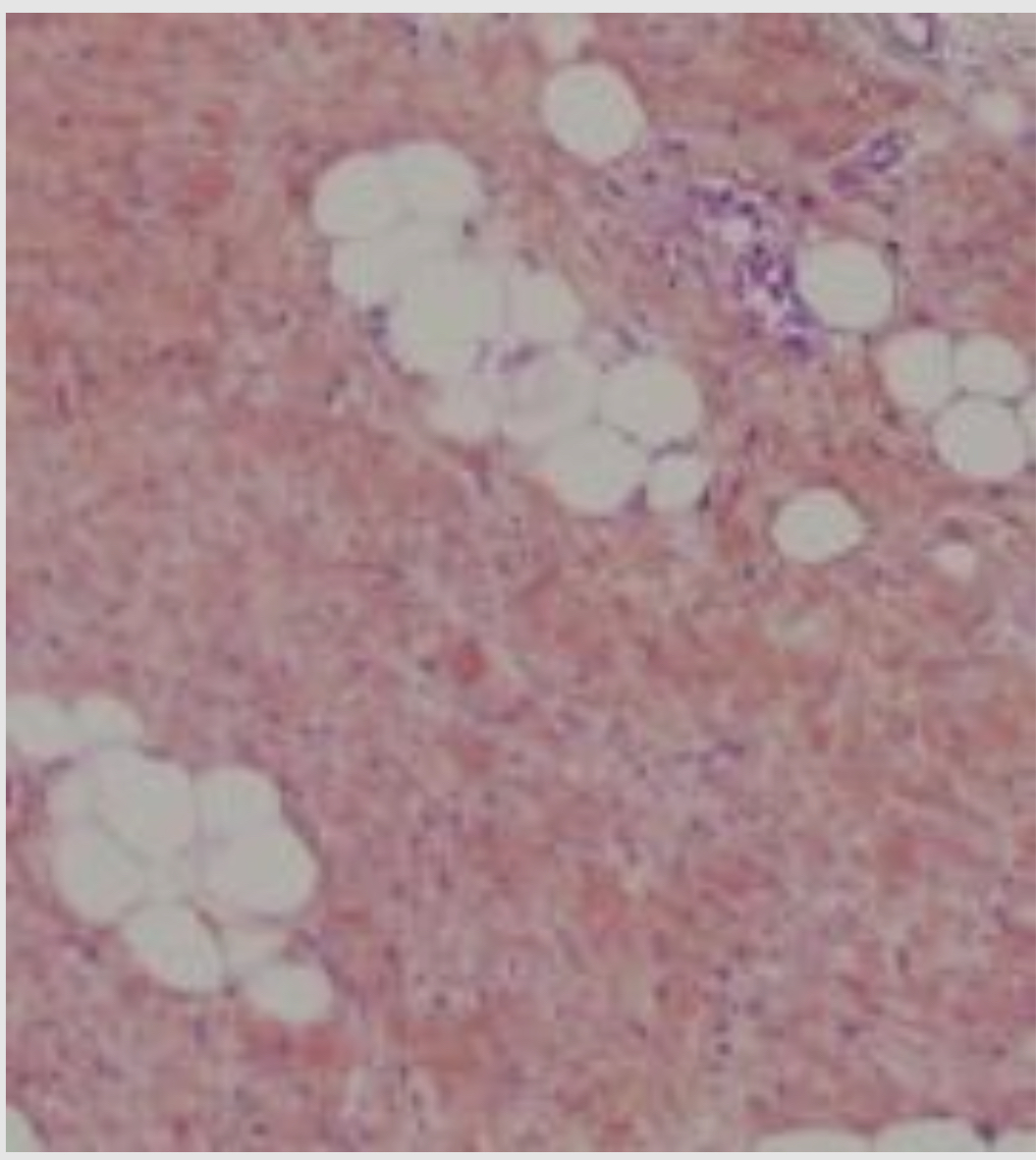 <p>Les adipocytes sont isolés ou regroupés en amas dans les tissus conjonctifs communs et il s’agit du type cellulaire prédominant dans le tissu adipeux (95% du tissu adipeux est constitué d’adipocytes) </p>