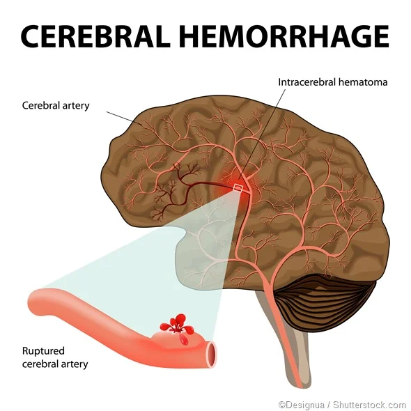 <p>Hemorrhage</p><p> (severe headache, vision changes, confusion and weakness on one side of your body. Chest pain and coughing up blood. Swelling or a feeling of fullness, abdominal bruising and bloody vomit, pee or poop.)</p>
