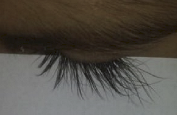 <p>Eyelashes that exceed the normal length (12mm) or thickness.</p>