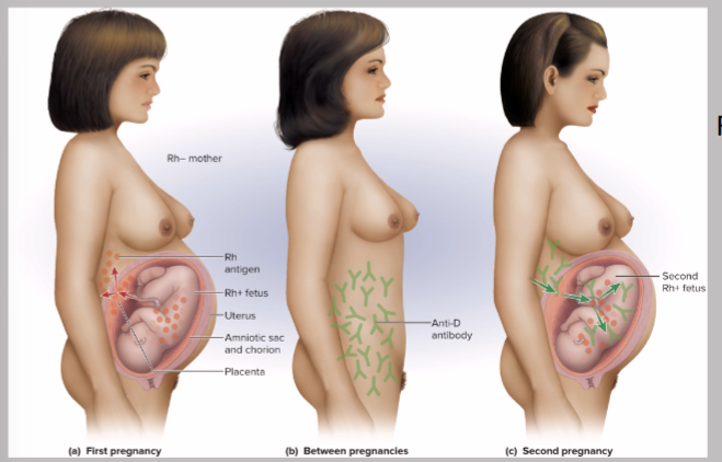 <p>Rh antibodies attack fetal blood, causing severe anemia</p>