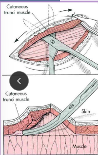 <p><span>Skin Tension relief Surgery Techniques</span></p>