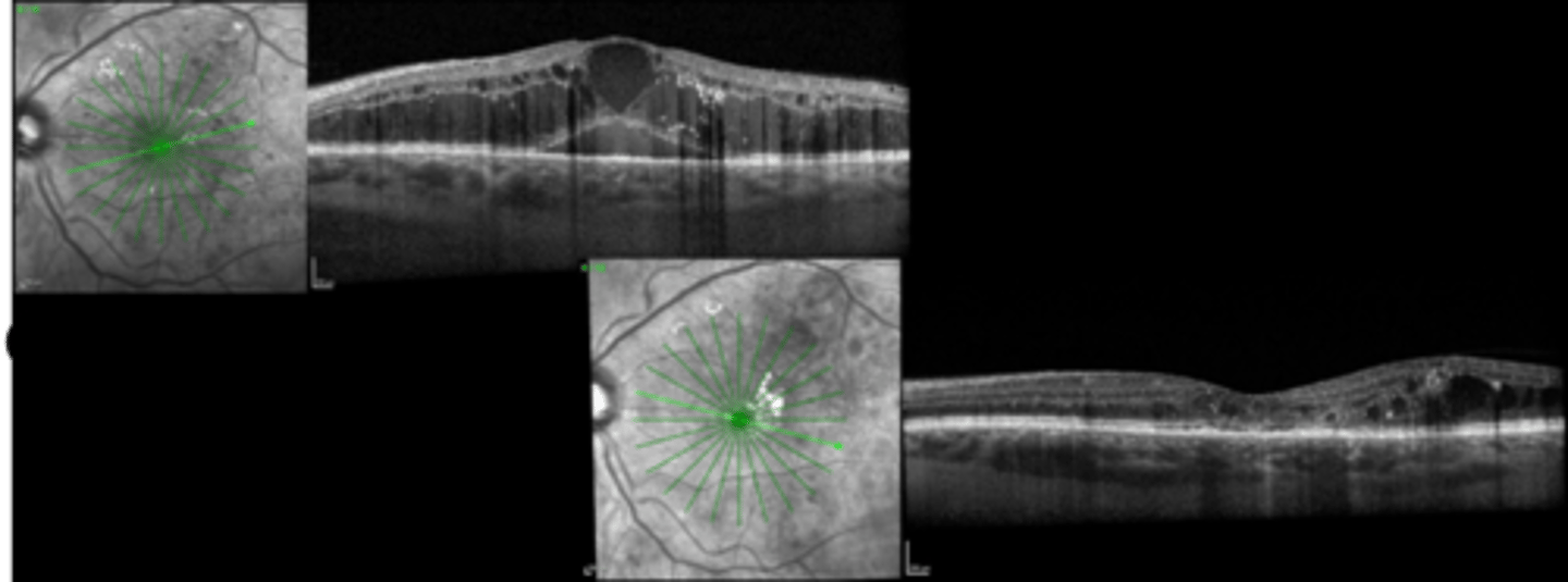 <p>What is the referral and f/u timeline for treating mac edema with anti-VEGF?</p>